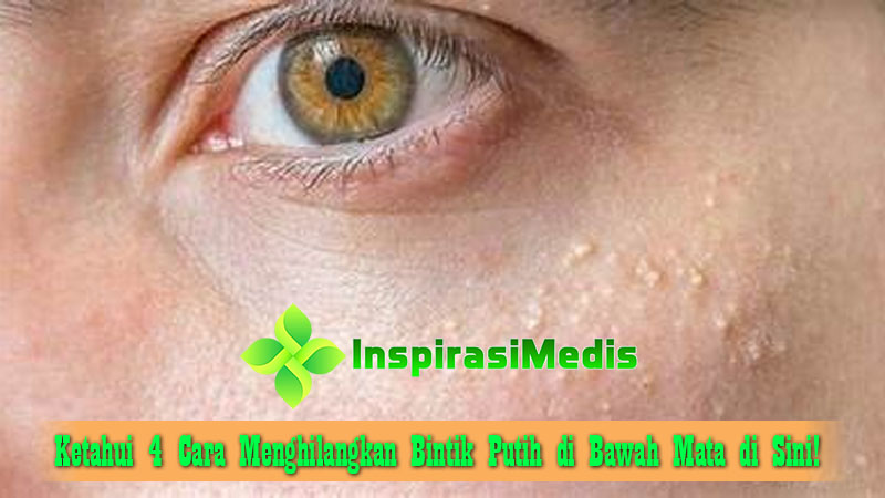 Ketahui 4 Cara Menghilangkan Bintik Putih di Bawah Mata di Sini!