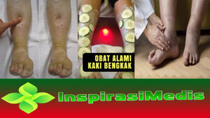 7 Obat Alami Kaki Bengkak secara Medis