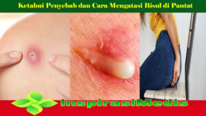 Ketahui Penyebab dan Cara Mengatasi Bisul di Pantat