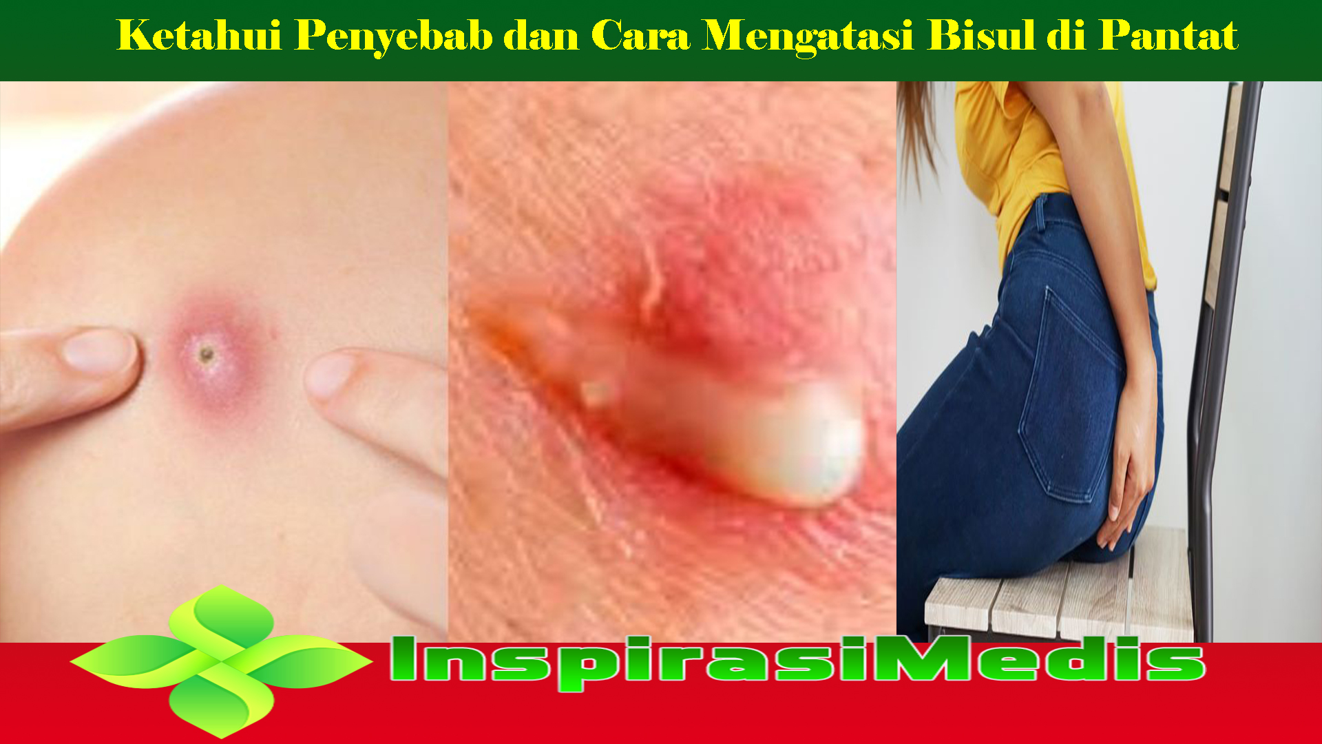 Ketahui Penyebab dan Cara Mengatasi Bisul di Pantat