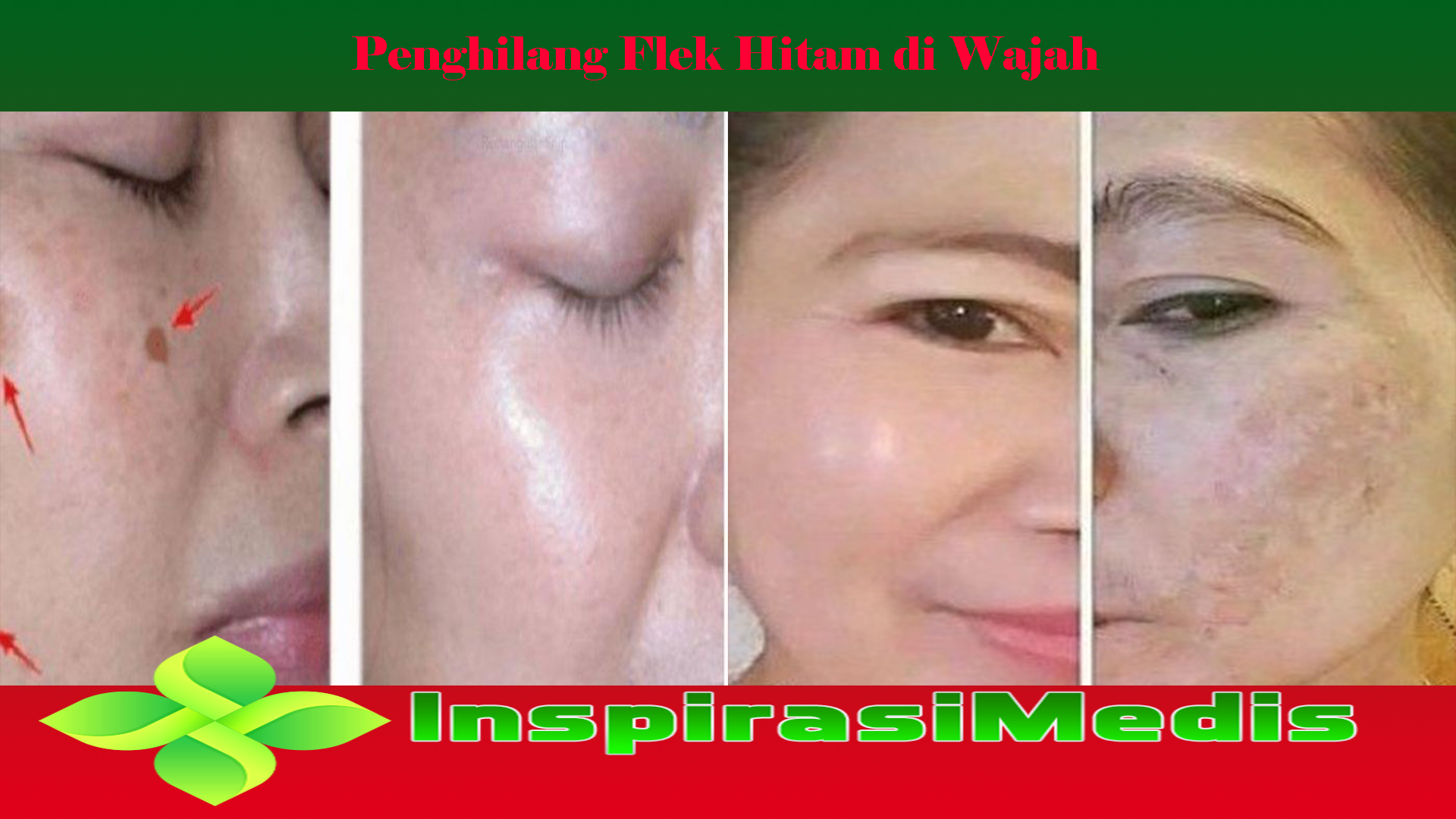 Penghilang Flek Hitam di Wajah