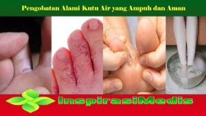 Alami Kutu Air Pengobatan yang Ampuh dan Aman