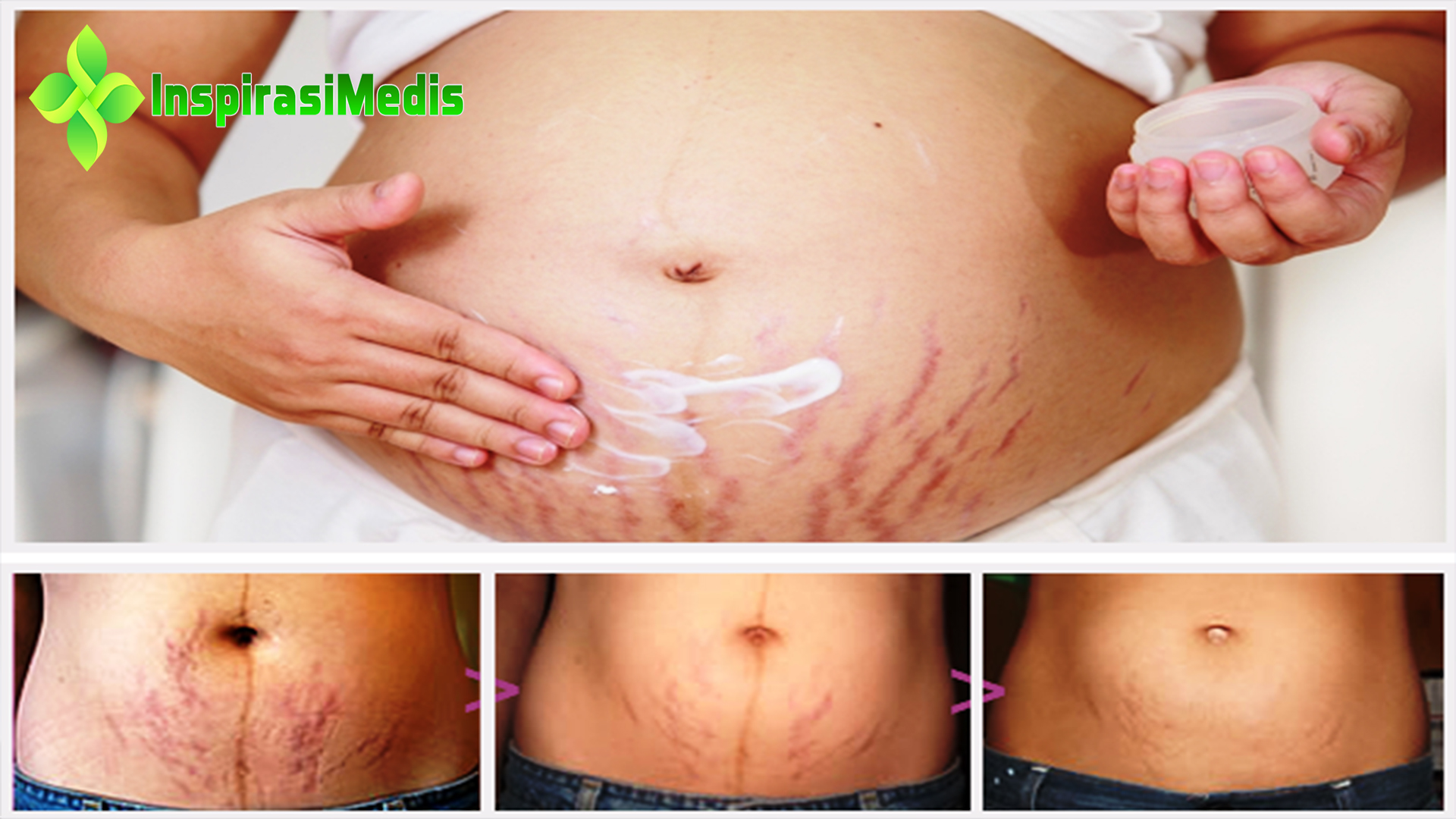 Ketahui Penyebab Stretch Mark dan Cara Mencegahnya