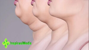 Inilah 7 Cara Menghilangkan Double Chin