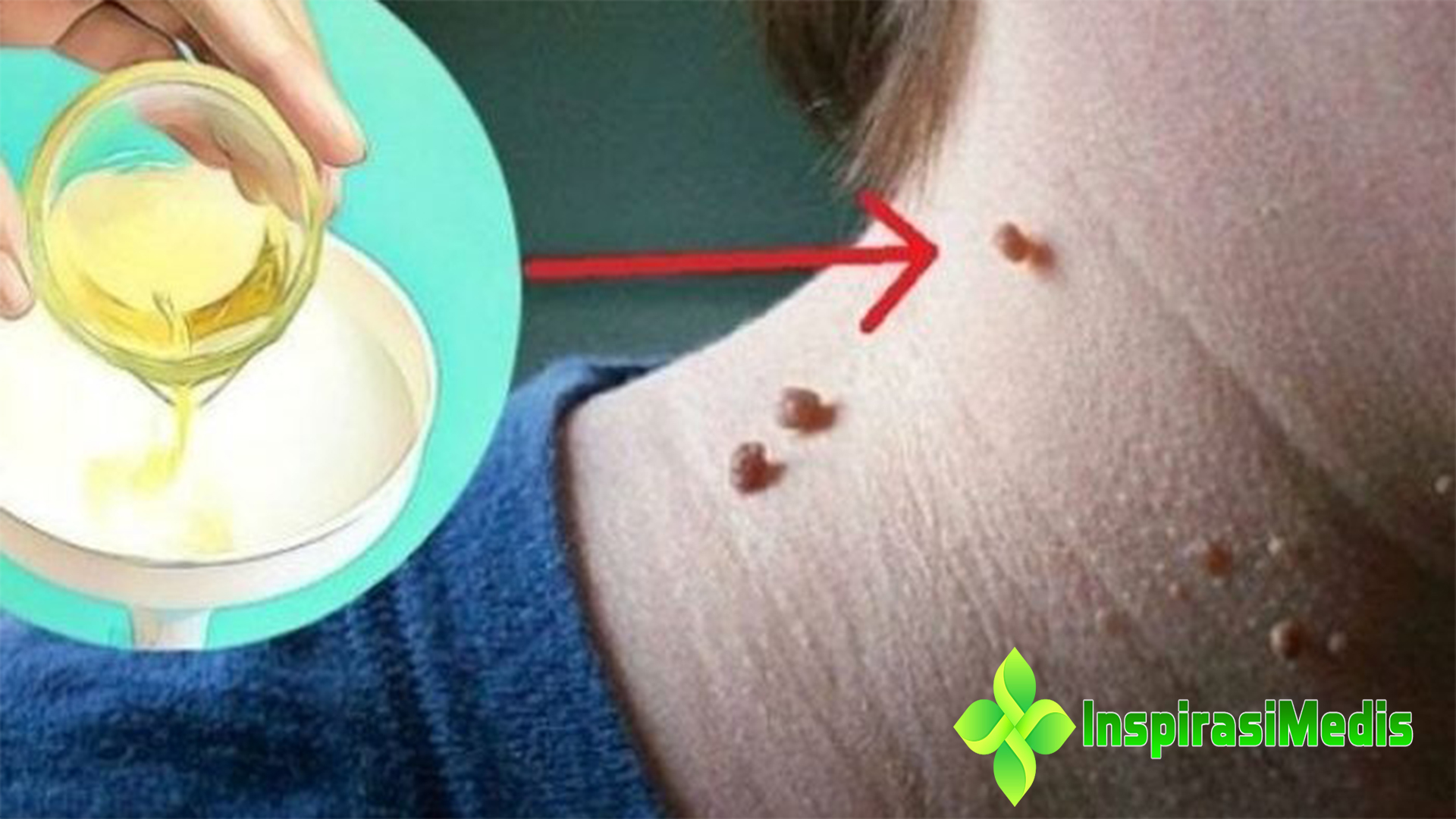 Cara Menghilangkan Kutil Secara Alami