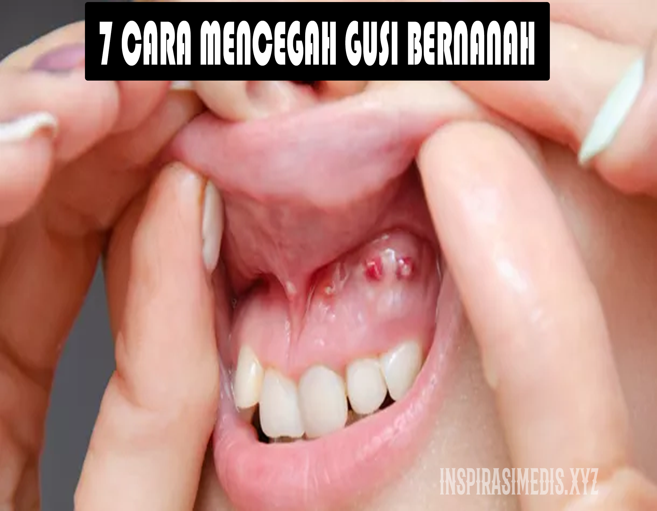 7 Cara Mencegah Gusi Bernanah